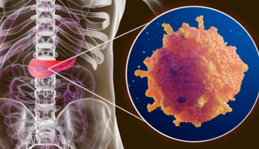 研究人員揭示胰腺癌轉(zhuǎn)移機(jī)制