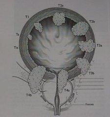 中山大學(xué)林天歆團(tuán)隊(duì)揭示膀胱癌淋巴轉(zhuǎn)移提供系統(tǒng)性的解決策略