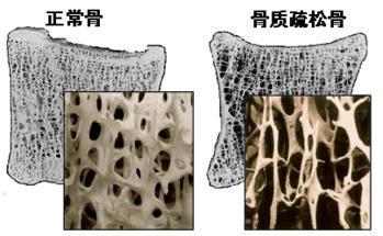 英國(guó)的骨質(zhì)疏松癥治療率不再上升