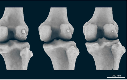 人類正在失去與骨關(guān)節(jié)炎相關(guān)的膝骨 現(xiàn)在正在卷土重來(lái)