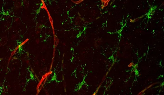 科學家鑒定出促進腦轉移的蛋白質