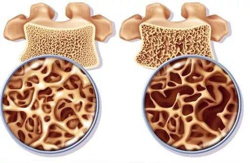 骨質(zhì)疏松癥篩查無需證明有益