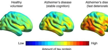 腦成像可以預(yù)測(cè)阿爾茨海默氏癥相關(guān)的記憶力減退