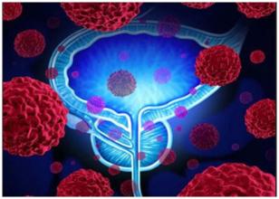 建立新的聯(lián)合療法對前列腺癌安全有效