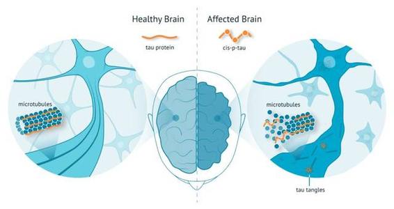 腦成像將阿爾茨海默氏癥的下降與tau蛋白聯(lián)系起來(lái)