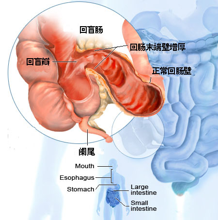 克羅恩氏病是一種以胃腸道的慢性炎癥和纖維化為特征的疾病