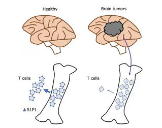 腦癌可通過在骨髓中捕獲T細(xì)胞來抵抗免疫治療