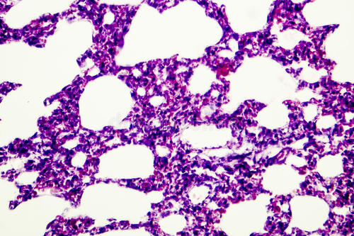 蒸氣味中的化學(xué)物質(zhì)對肺組織造成廣泛損害