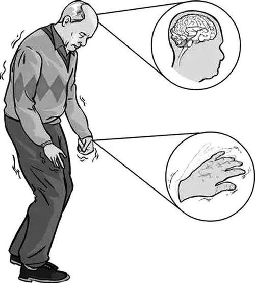 帕金森氏病的自動(dòng)階段鑒別與生物集成