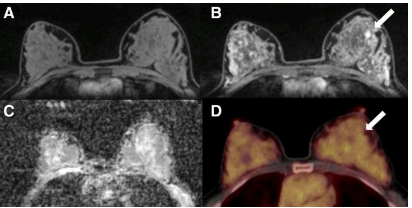 PET/MRI可識別出顯著的乳腺癌影像生物標(biāo)志物