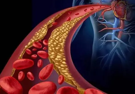 HeartCare研究確定患者患心血管疾病的遺傳風險