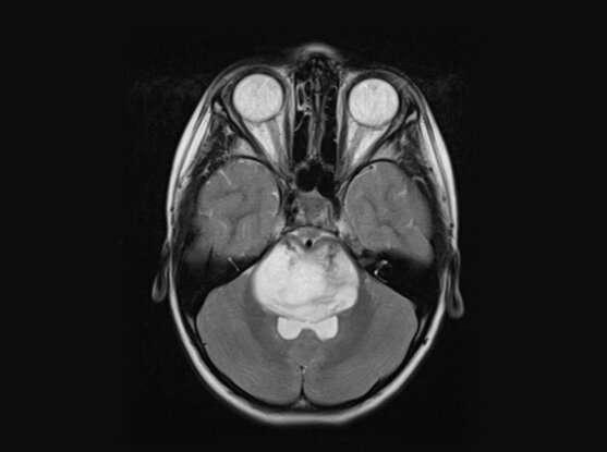 研究人員確定了治療侵襲性兒童腦腫瘤的新靶點(diǎn)
