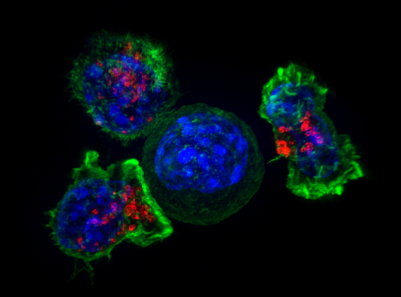 研究團隊發(fā)現(xiàn)實體瘤中 CAR T 細胞的新靶點