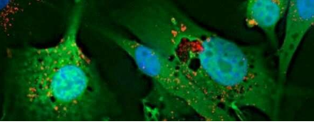 ChemoID 試驗(yàn)顯示膠質(zhì)瘤患者的生存率增加