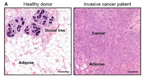 健康乳腺脂肪細胞對抗乳腺癌的力量