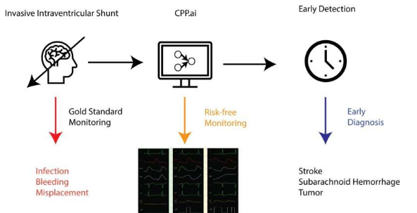 人工智能驅(qū)動的工具可以改善重癥監(jiān)護(hù)患者的腦壓監(jiān)測