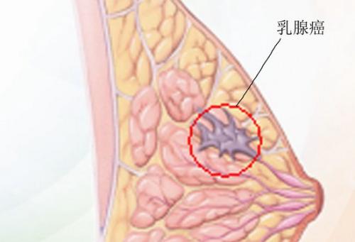 新的基因捕獲揭示了潛在的乳腺癌治療目標