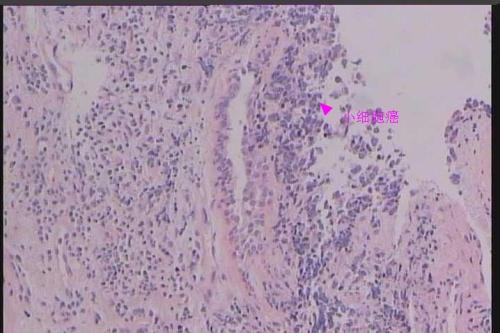 Pembrolizumab可有效作為晚期非小細胞肺癌的一線治療藥物