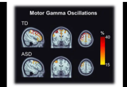 自閉癥兒童的腦電活動(dòng)變化