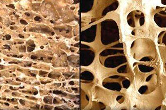 信號通路可能是改善骨質(zhì)疏松癥治療的關鍵