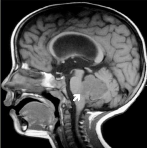 研究人員呼吁對(duì)兒童腦癌進(jìn)行常規(guī)基因篩查