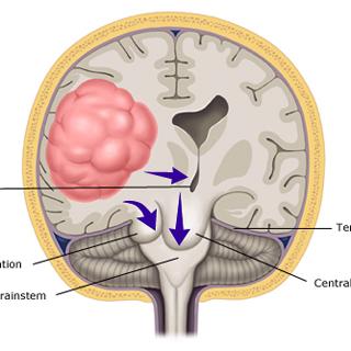 新的計算策略發(fā)現(xiàn)腦腫瘤縮小分子