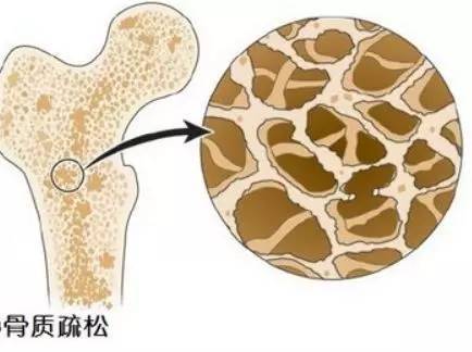 甲狀旁腺激素復(fù)合物的近原子圖指向骨質(zhì)疏松癥的新療法